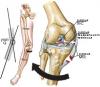valgus_acl.jpg
