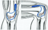 menisc_ethio2.gif