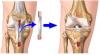 anterior-cruciate-ligament-BTB1.jpg